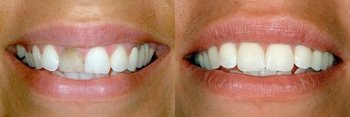 Smile Gallery - Ogden Dental, Naperville Dentist