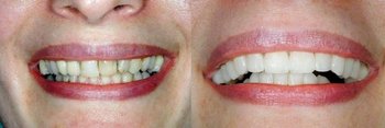 Smile Gallery - Ogden Dental, Naperville Dentist