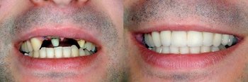 Smile Gallery - Ogden Dental, Naperville Dentist