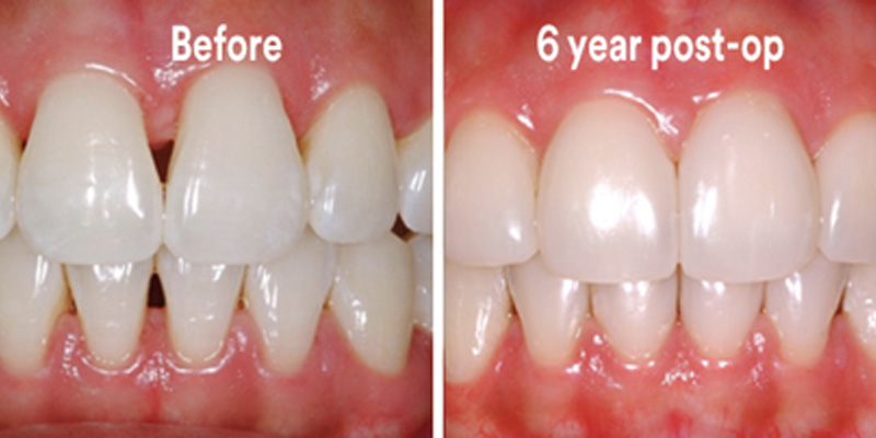 BioClear Diastema Closure and Black Triangle Closure  - Ogden Dental, Naperville Dentist