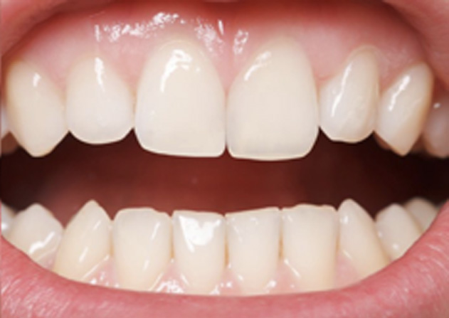 Cosmetic Bonding  - Ogden Dental, Naperville Dentist