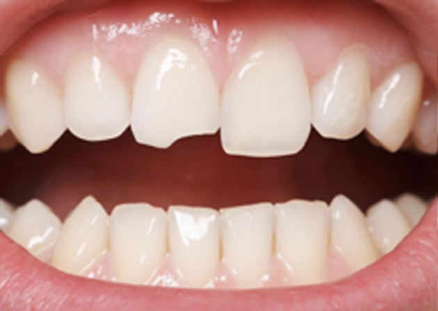 Cosmetic Bonding  - Ogden Dental, Naperville Dentist