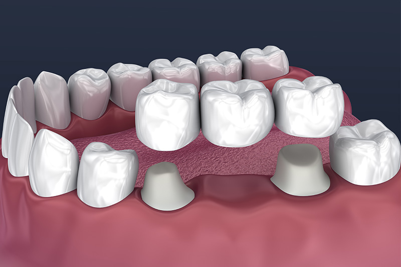 Crowns and Bridges, Inlays and Onlays  - Ogden Dental, Naperville Dentist