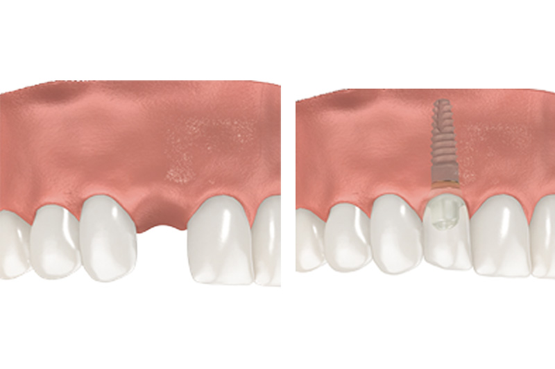 Dental Implants - Ogden Dental, Naperville Dentist