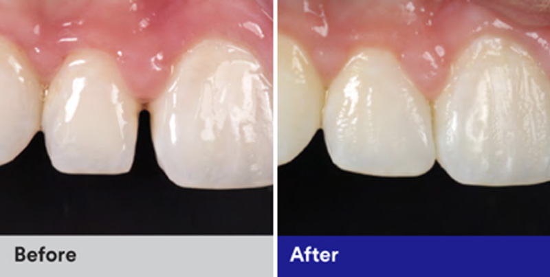 BioClear Diastema Closure and Black Triangle Closure  - Ogden Dental, Naperville Dentist