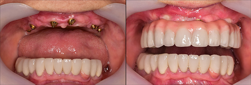Implant Overdentures and Fixed All-On-X Treatment  - Ogden Dental, Naperville Dentist