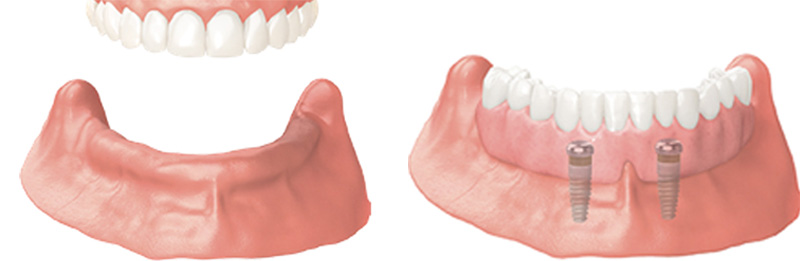 Implant Overdentures and Fixed All-On-X Treatment  - Ogden Dental, Naperville Dentist