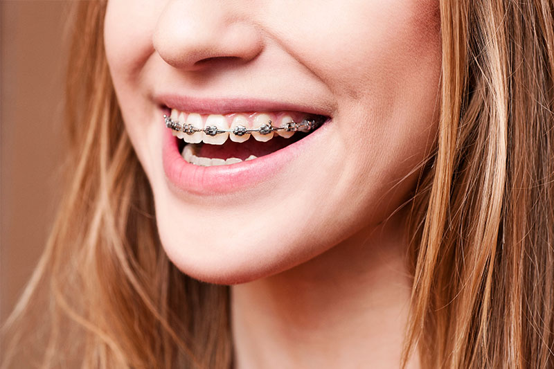 Orthodontics - Ogden Dental, Naperville Dentist