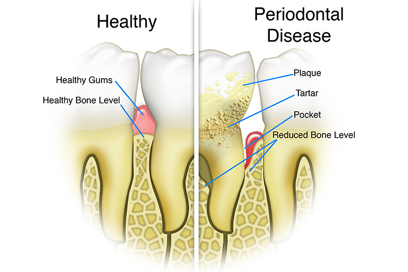 Scaling & Root Planings (Deep Cleanings)  - Ogden Dental, Naperville Dentist