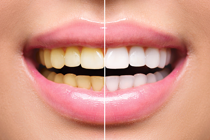 Teeth Whitening - Ogden Dental, Naperville Dentist