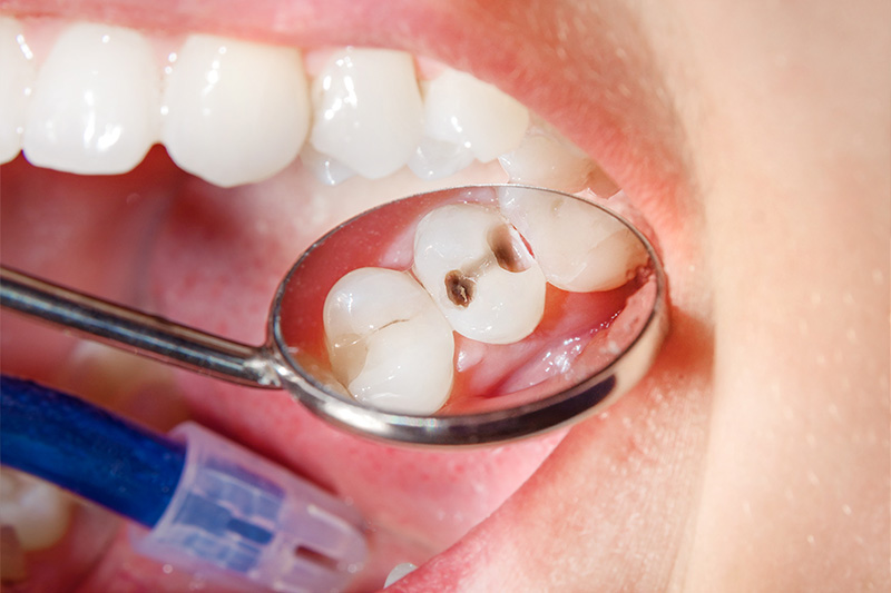 Tooth Colored Composite Fillings  - Ogden Dental, Naperville Dentist