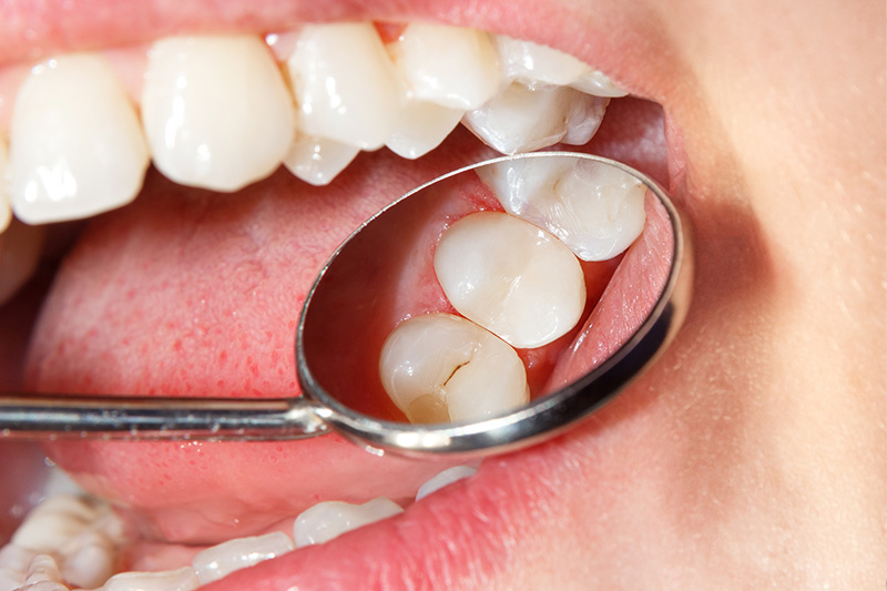 Tooth Colored Composite Fillings  - Ogden Dental, Naperville Dentist