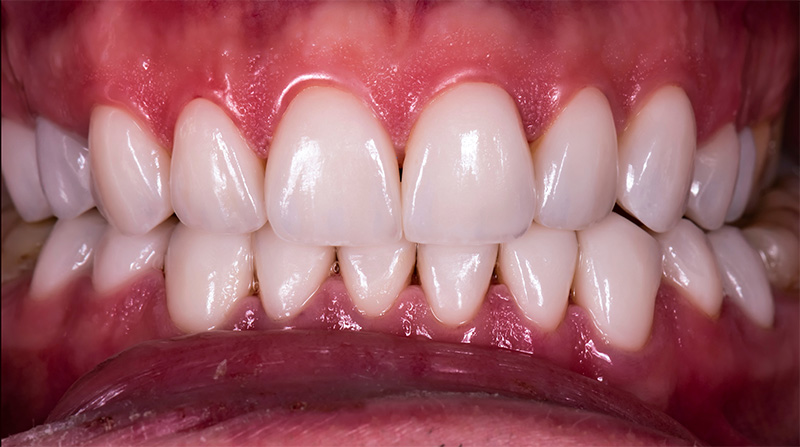 Veneers  - Ogden Dental, Naperville Dentist