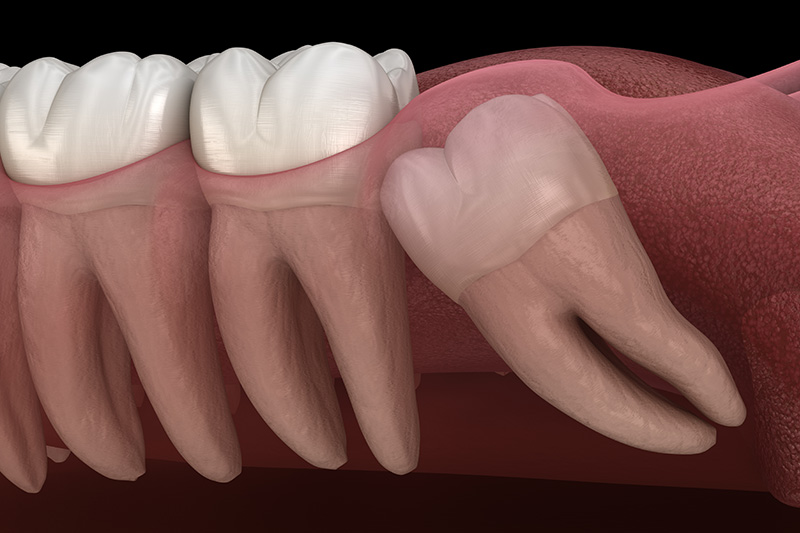 Wisdom Teeth Extractions (with Sedation)  - Ogden Dental, Naperville Dentist